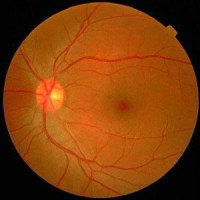 Retina